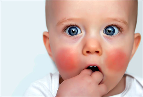 Teething and eczema